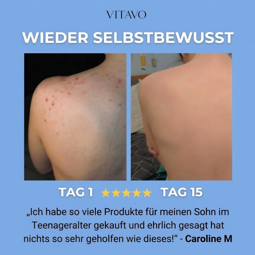 Anti-Akne-Seife