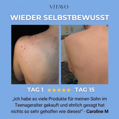 Anti-Akne-Seife