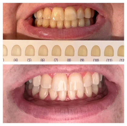 Teeth Whitening Strips