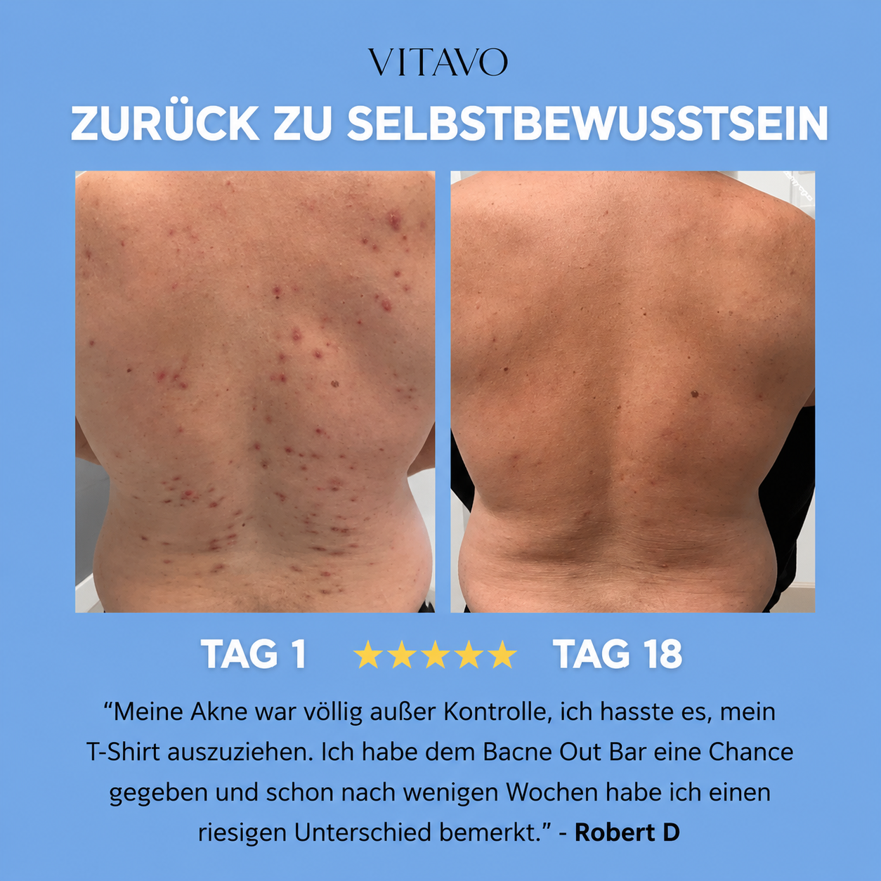 Anti-Akne-Seife